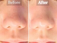 ボーンオム(Born Homme)/毛穴洗浄＋美容液導入：20代女性