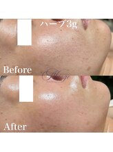 ニュアージュ(Nuage)/ハーブトリートメント