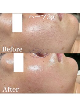 ニュアージュ(Nuage)/ハーブトリートメント