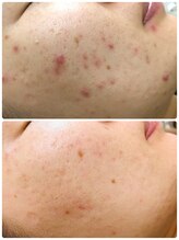 アンジェロ/【ニキビケア】肌育プログラム