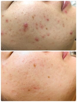 アンジェロ/【ニキビケア】肌育プログラム