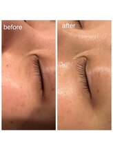 セラピーラボ(Therapy Lab)/【美容】最新ハイドロ　クマ撃退