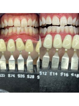 トウキョースワーズ 渋谷店(TOKYO SWRS)/#ホワイトニング #渋谷 #池袋