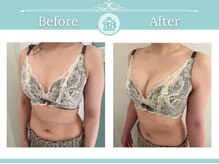 美人バスト 本厚木店/バストアップ◇症例◇