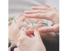メディカルサロン MARUYAMAの雰囲気（健康美容【 鍼 】全身の様々なお悩みに。自然治癒力を高めます。）