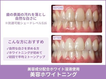 クレア(Crea)/【歯のホワイトニング症例写真】