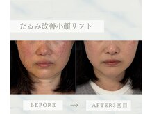 ソラ(Sola)/たるみ改善小顔リフト