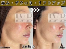 ラヴレボーテ(La Vraie Beaute)/小顔コルギ・ヒト幹細胞導入
