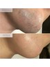 【毎朝のヒゲ剃りをラクに】男性1番人気ヒゲ脱毛 ¥2,200