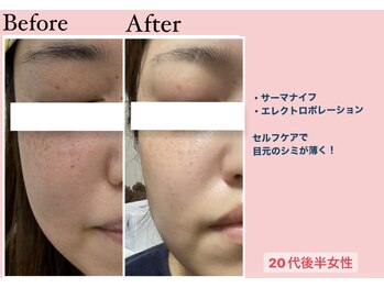 じぶんdeエステ 梅田店/症例 サーマナイフ・エレポレ