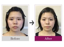 ビコツゼロ 心斎橋(BIKOTSU ZERO)/小顔・エラ張り・むくみ