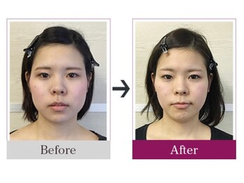 ビコツゼロ 心斎橋(BIKOTSU ZERO)/小顔・エラ張り・むくみ