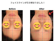 ベル/20代の方の小顔Before After