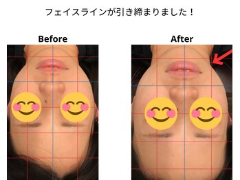 ベル/20代の方の小顔Before After