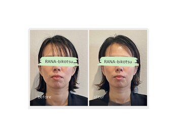 ラーナビコツ(RANA-bikotsu)/【整顔】小顔矯正