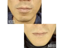 ビークラン(BecraN)/ヒゲ脱毛！