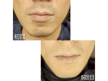 ビークラン(BecraN)/ヒゲ脱毛！