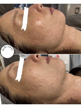 ベルサロン(Belle salon)/高濃度ミストガン×LDM×パック