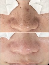 ニュートラル(neutral)/毛穴エクストラクションプロ大分