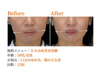 シルエラバレ(CiruelaValle)/Before After