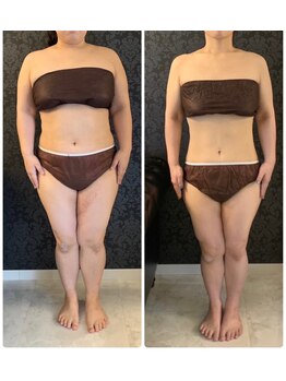 ミカ ネスト(Mika Nest)/カッピング(吸い玉)