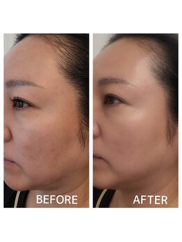 リンド(Lindo)/　A Cトリートメント