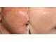 アティロン(Attirant)の写真/【ニキビ、皮膚炎】繰り返す慢性肌トラブル