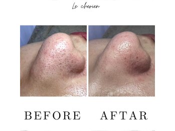 ルシェリア(Le cherien)/ハイドラフェイシャル