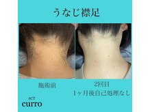 アクト クロ(ACT curro)/【うなじ襟足】脱毛施術例
