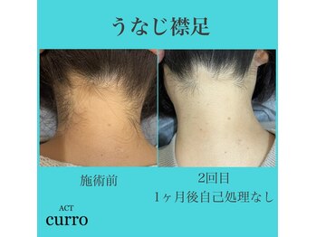 アクト クロ(ACT curro)/【うなじ襟足】脱毛施術例