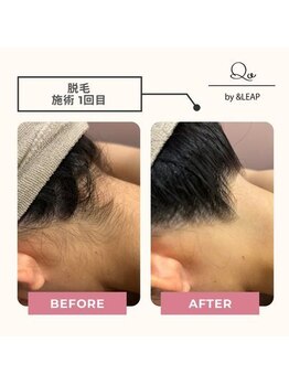 キュオバイアンドリープ(Qo by &LEAP)/全身脱毛でどこから見ても美しく