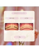 プラスビー 2号店(+b)/ホワイトニングビフォーアフター