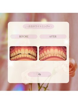 プラスビー 2号店(+b)/ホワイトニングビフォーアフター