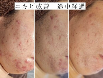 ユウビジン(YOU美人)/皮膚科軟膏 卒業