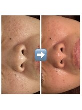 ルソワン(Le.soin)/毛穴悩みも改善◎