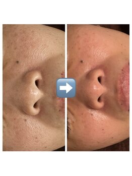 ルソワン(Le.soin)/毛穴悩みも改善◎