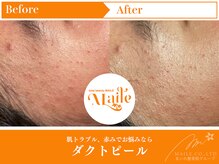 まいれ鍼灸院整骨院 整体院 草津院/ダクトピール/赤み/肌トラブル