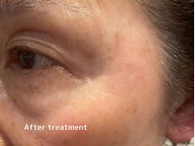 オアシスラグーン(OASIS LAGOON)/しわケア（症例２：after）