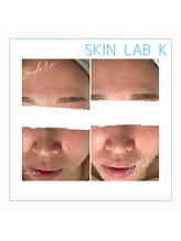 スキン ラボ ケー(Skin lab K)/低温プラズマ+アクネケア