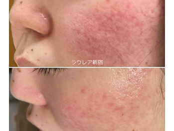 ラウレア/敏感肌/赤み/乾燥/花粉ダメージ