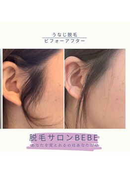 ベベ(Bebe)/もみあげ脱毛♪