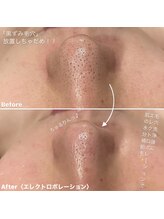 ミエル 恵比寿店(Miel)/エレクトロポレーション毛穴洗浄