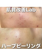 肌質改善Lab｜韓国美容/毛穴/ハーブピーリング/ニキビケア｜/ハーブピーリング｜ニキビケア