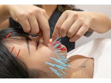 100本以上刺す美容マロン鍼でお悩みはもちろん肌質改善します！