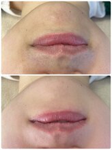 ハグ(Hug)/フェイシャルワックス＋光フォト