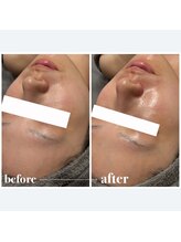 ナーズプラス リベルテ(Naz Plus/Liberte)/リジュラン肌育ケアコース