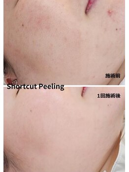 ユニ(uni.)/ショートカットピーリング