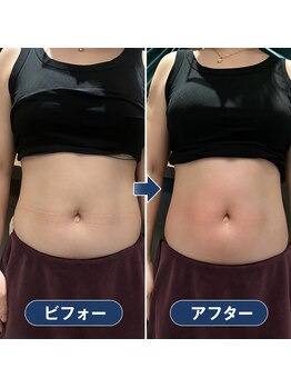 ハイケアビューティー(Hi-Care Beauty)の写真/【脂肪撃退】最新温熱マシンで落ちにくいい脂肪もスッキリと！1回でも効果を実感◎
