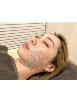 鍼灸施術を受けたい