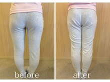 カイロライン 神楽坂通り整体院/産後骨盤矯正×お尻/beforeafter